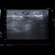 Angiolipoma, subcutaneous, selective embolisation: US - Ultrasound
